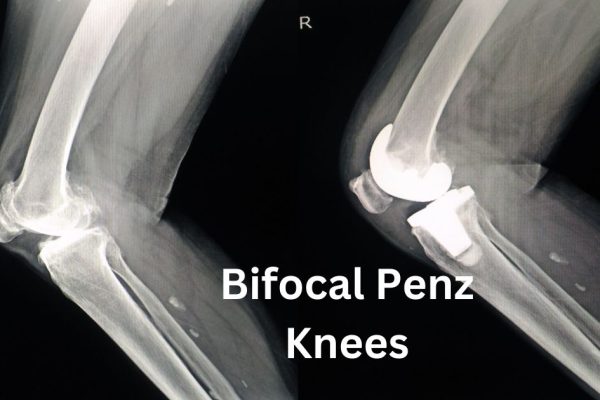 Unveiling the Mystery Behind Bifocal Penz Knees